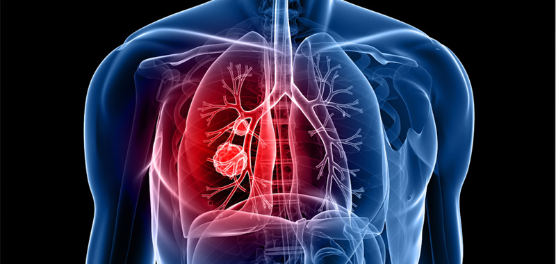 Asbestos—Lung Cancer