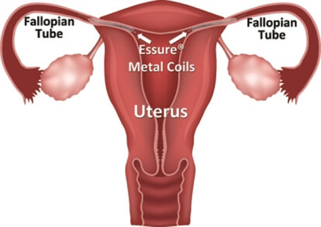 Essure®