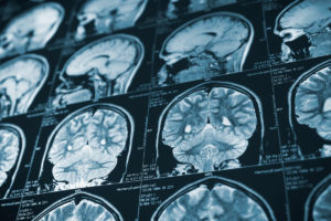 Why You Can’t Rely on a CT Scan or MRI to Diagnose a Traumatic Brain Injury (TBI)