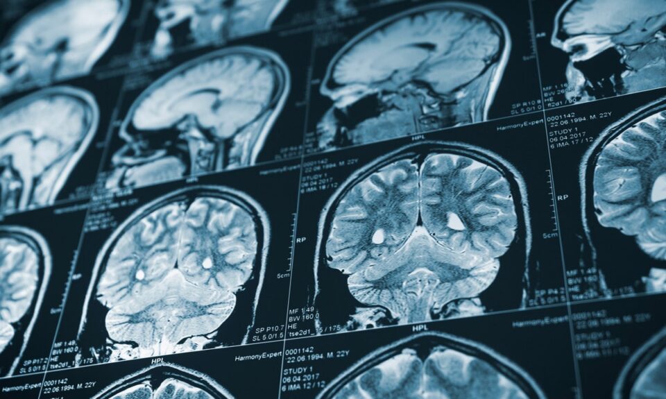 Why You Can’t Rely on a CT Scan or MRI to Diagnose a Traumatic Brain Injury (TBI)