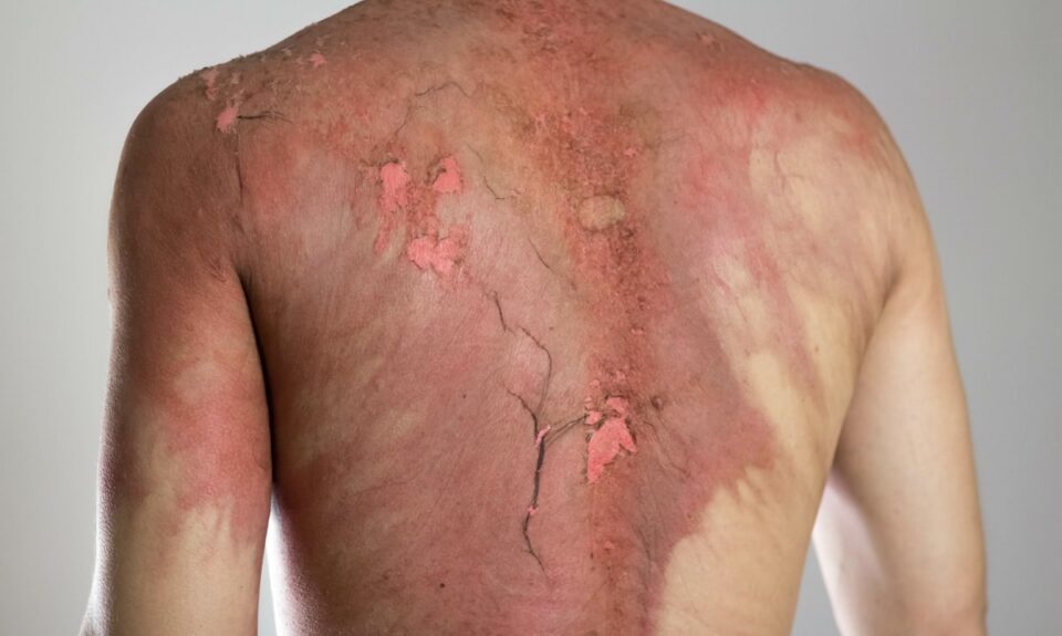 Burn Injuries—Severity and Cause